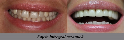fatete integral ceramica